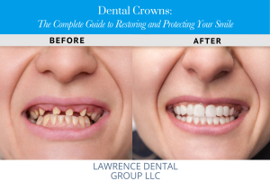 Dental Crowns The Complete Guide to Restoring and Protecting Your Smile